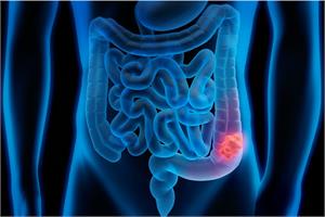 Could Fecal Transpalants correct colorectal cancer?