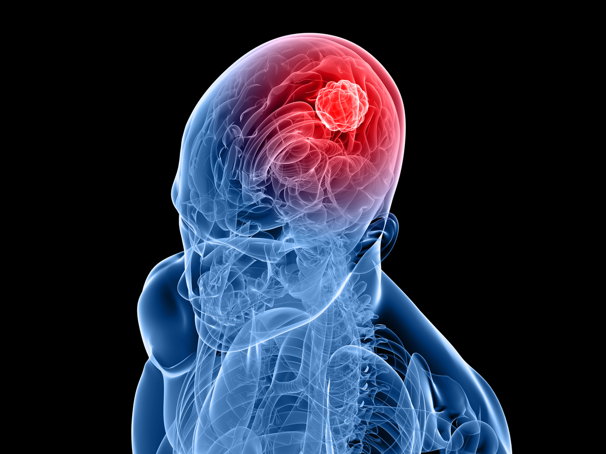 Ibudilast increases effectiveness of temozolomide in brain cancer