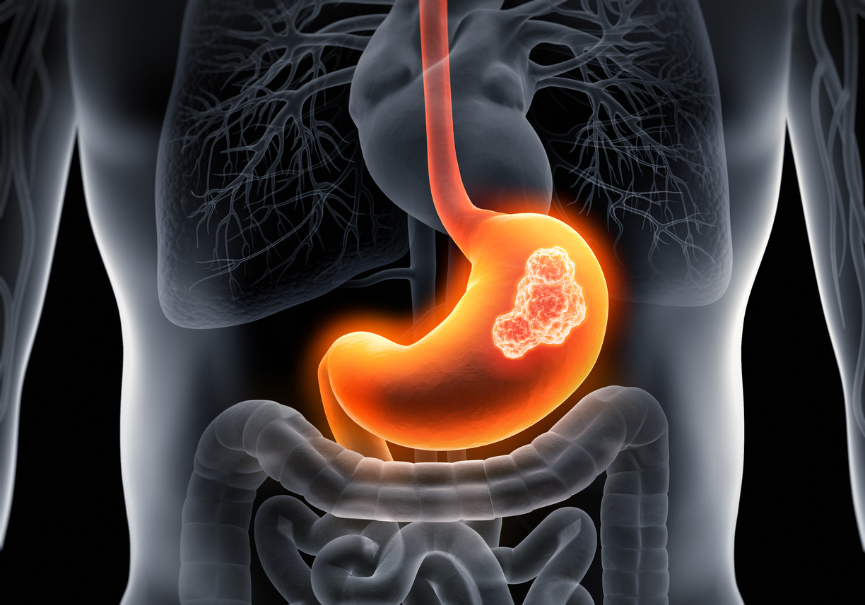 * Stomach Cancer - Latest News, Latest Research | CANCERactive