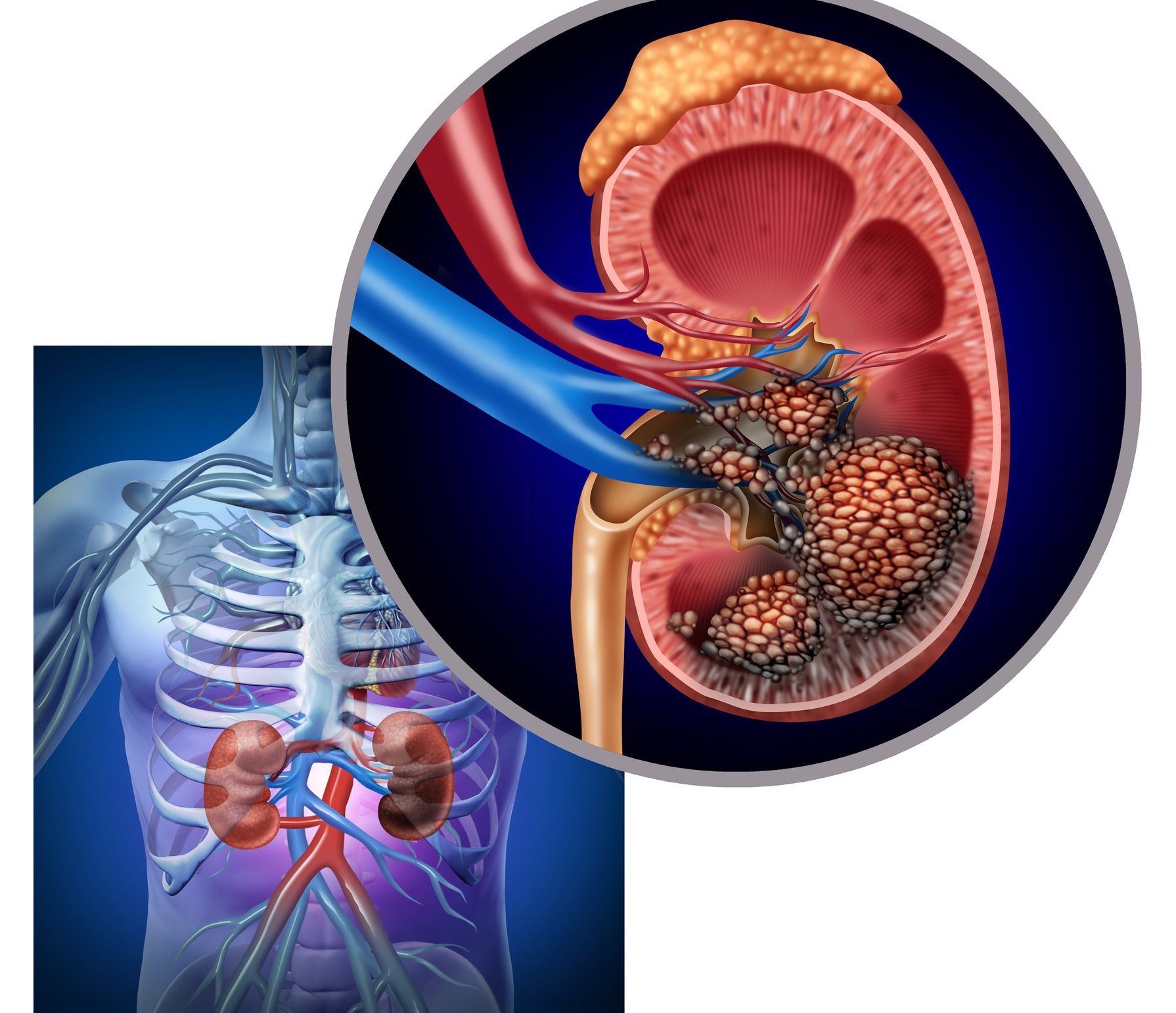  An Overview Of Kidney Cancer Symptoms Causes And Treatment 