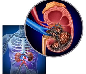 * An Overview of Kidney Cancer - symptoms, causes and treatment alternatives