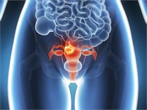 * Endometrial or Womb Cancer - Latest News, Latest Research | CANCERactive
