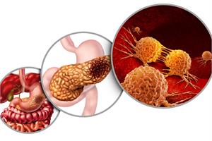 Pancreatic cancer links to cholesterol